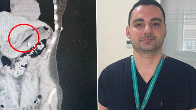 Kilo vermek için yaptı, ameliyata alındı! Doktorlar hayrete düştü: '13 santimetrelik cisim nasıl yutulur?'