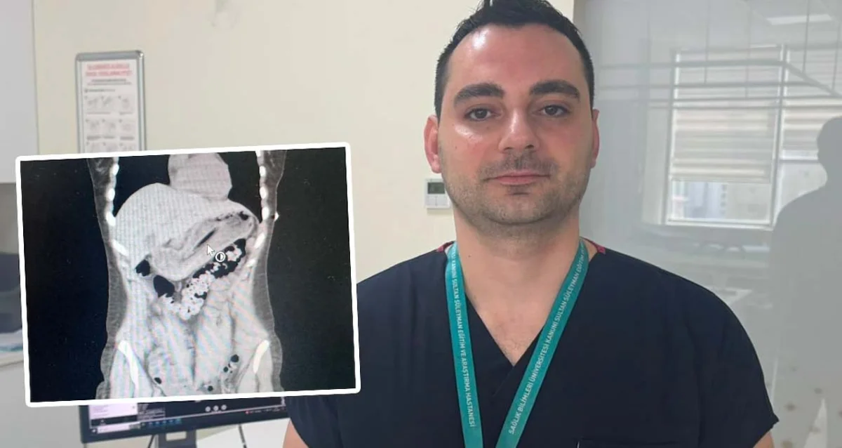 Zayıflamak isterken 13 santimetrelik diş fırçası yuttu: Doktorlar bile şaştı kaldı