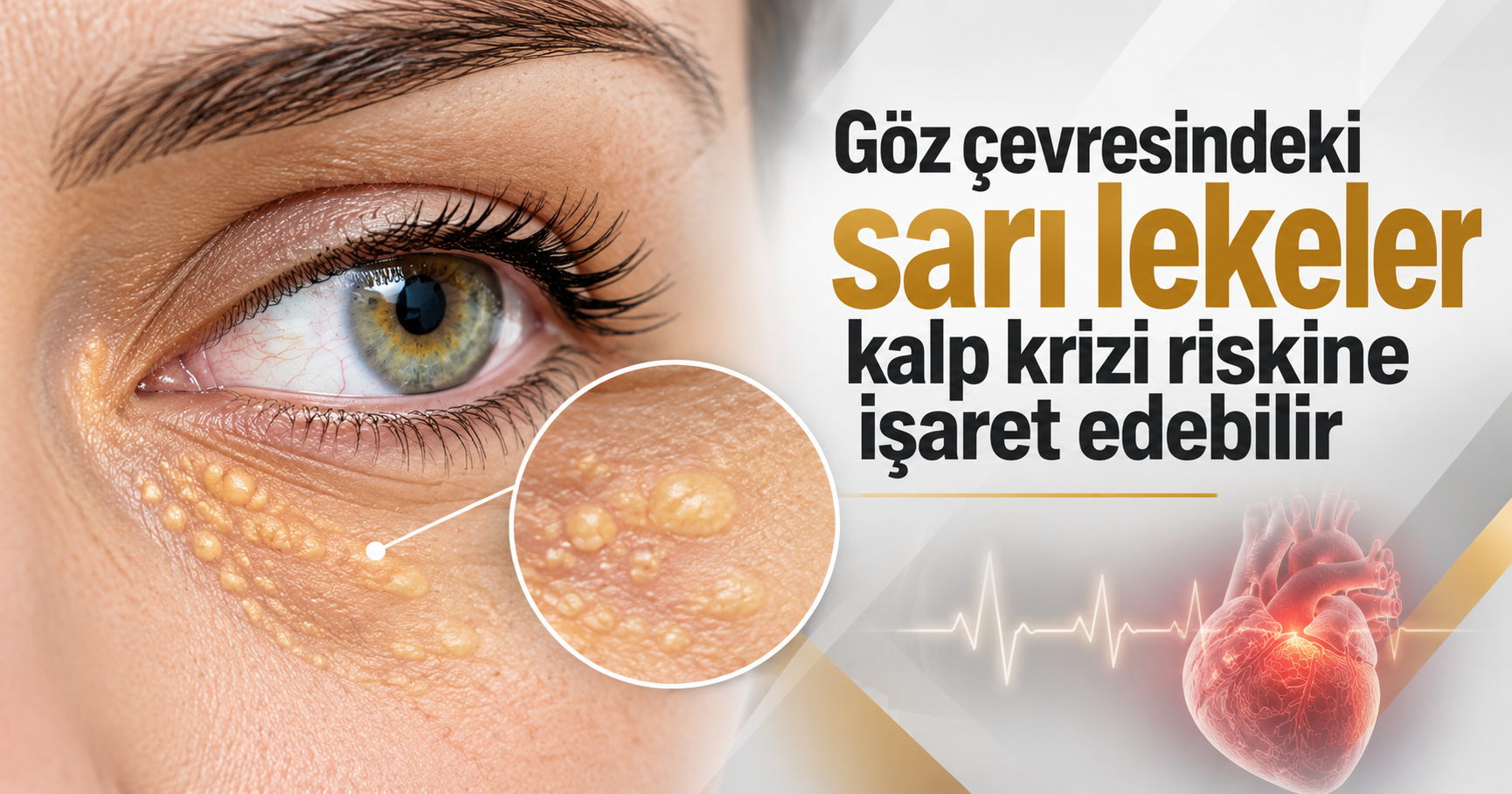 Göz çevresindeki sarı lekeler kalp ve beyin damarları için uyarı olabilir